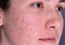 Beauty Tips For Face Pimples