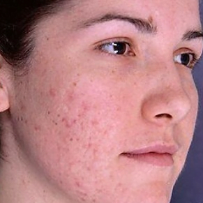 Beauty Tips For Face Pimples