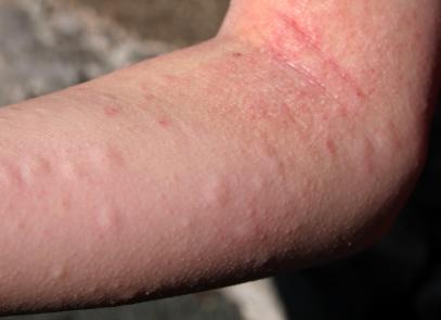 Allergy to dragon fruit symptoms