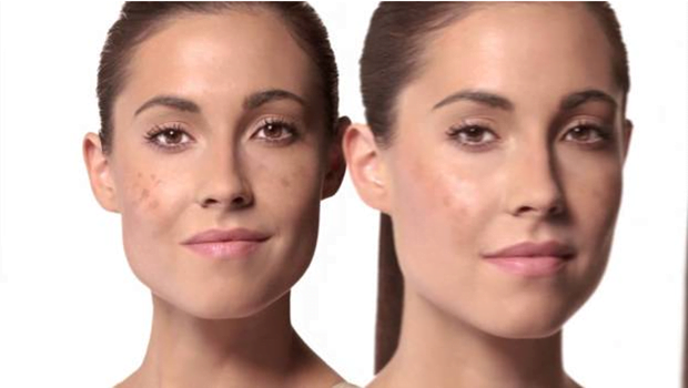 Removes Black Spots From The Skin