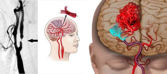 HOW MANY TYPES OF STROKES ARE THERE