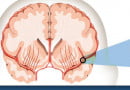WHAT IS STROKE