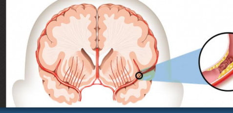WHAT IS STROKE