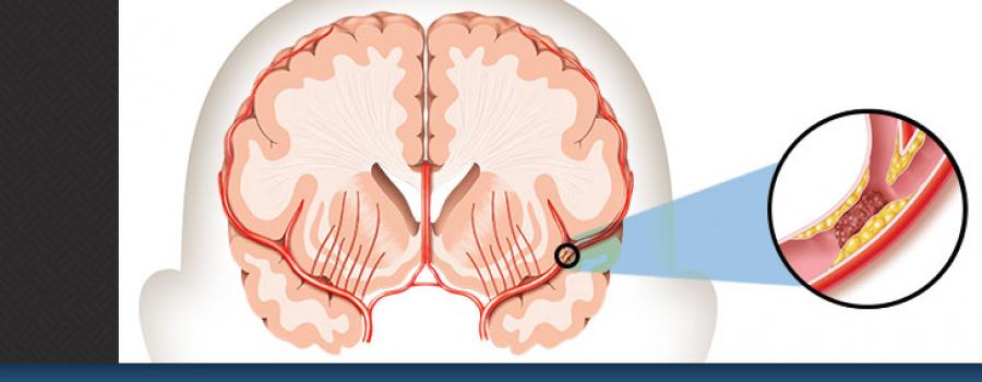 WHAT IS STROKE