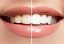 teeth cleaning cost