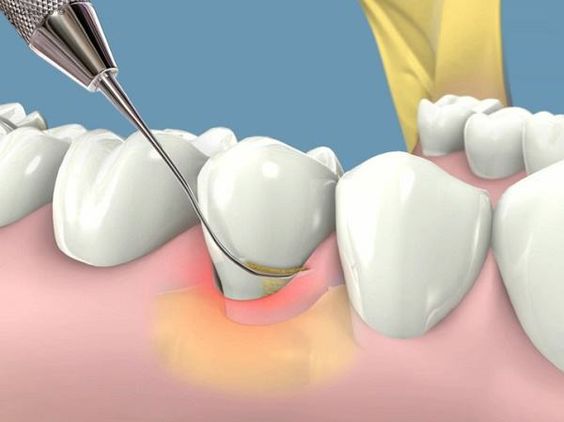 Benefits of Root Canal