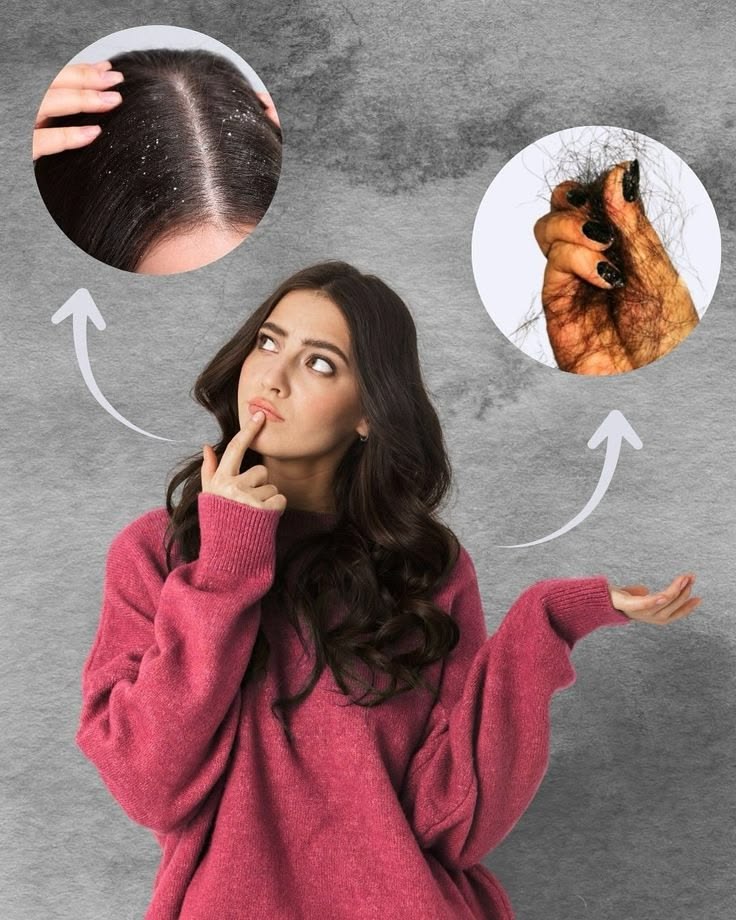 6 Home Remedies For Dandruff And Hair Fall