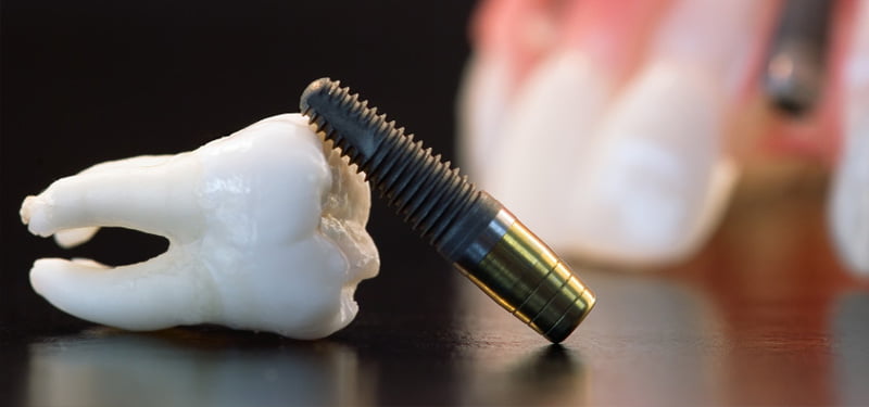 Disadvantages Of Tooth Implant