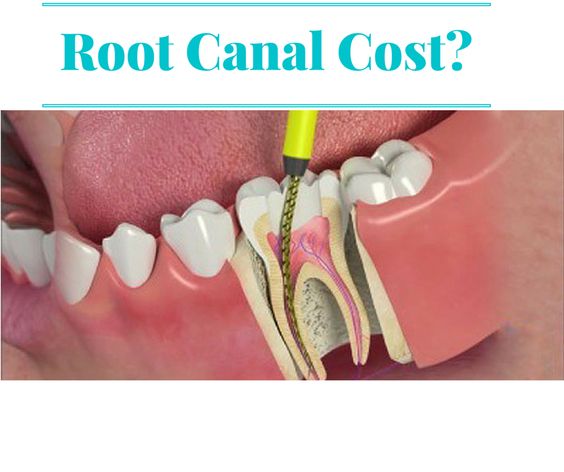 Root Canal