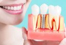 Tooth Implant Cost