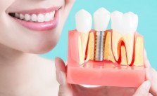 Tooth Implant Cost