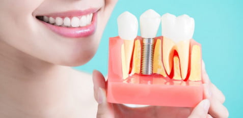 Tooth Implant Cost