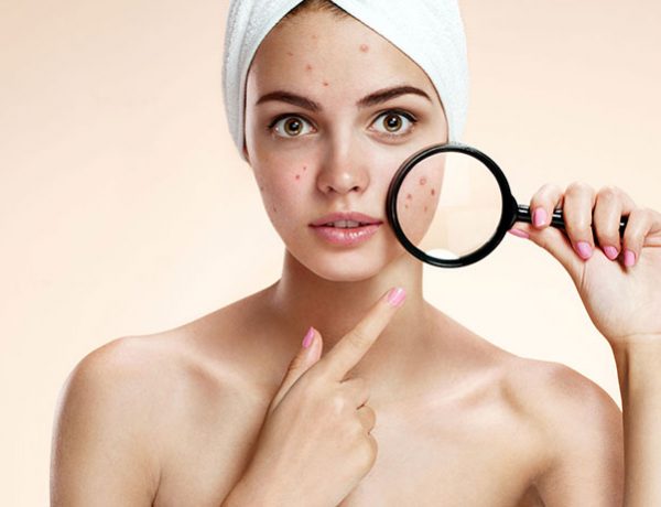 Treat Acne