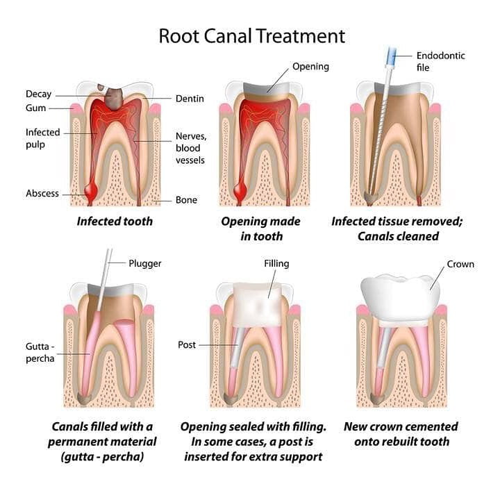 proedure of root canal