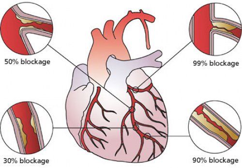What Is Heart Blockage
