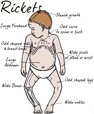rickets causes