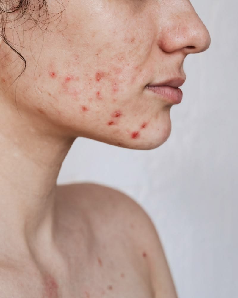 Reduce Acne