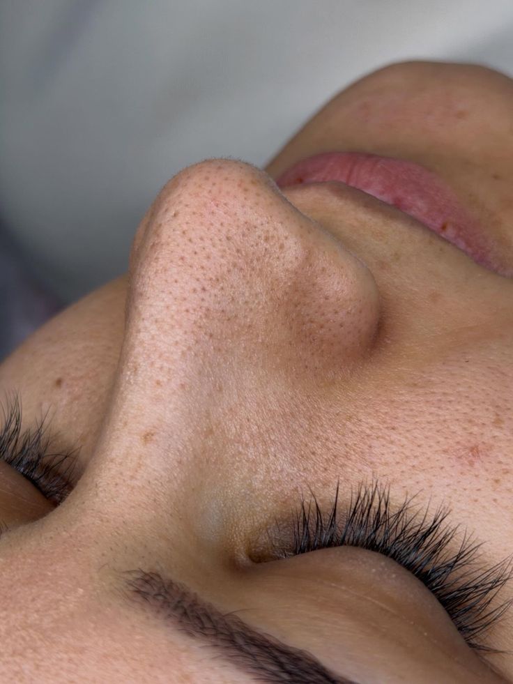 Remove Blackheads