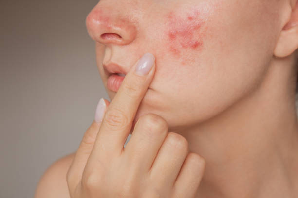 Acne