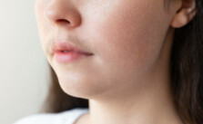 Facial Hair Removal