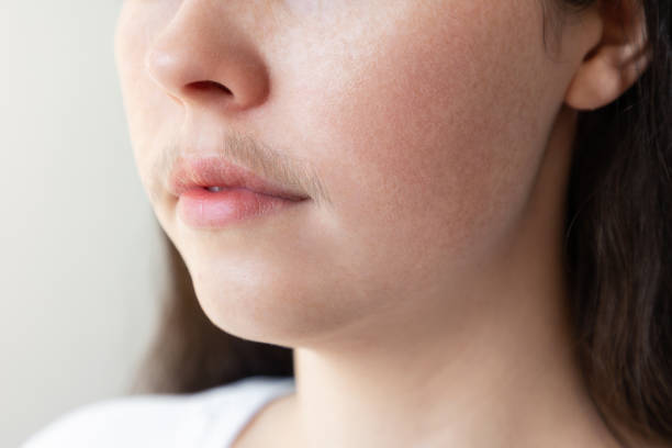 Facial Hair Removal