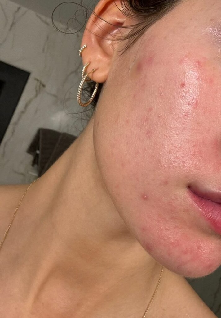 Skin Irritation