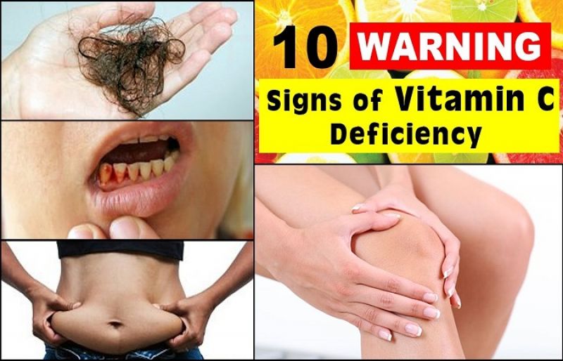 Vitamin C Deficiency