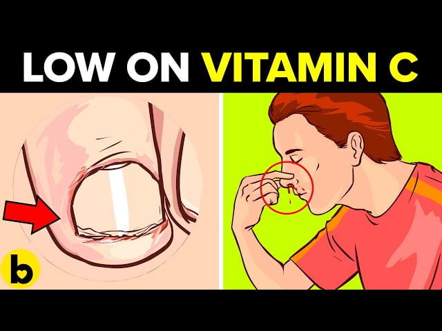 Vitamin C Deficiency1