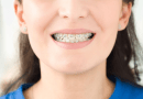 Concerned About Teeth Clip Price in India? 4 Things to Keep in Mind