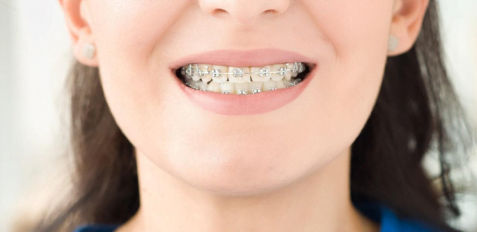 Concerned About Teeth Clip Price in India? 4 Things to Keep in Mind