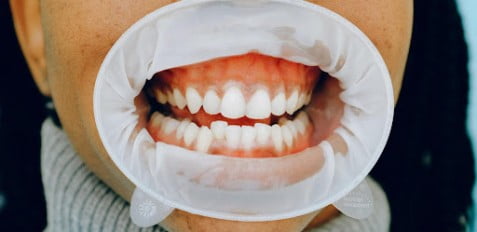 What are Clear Teeth Aligners