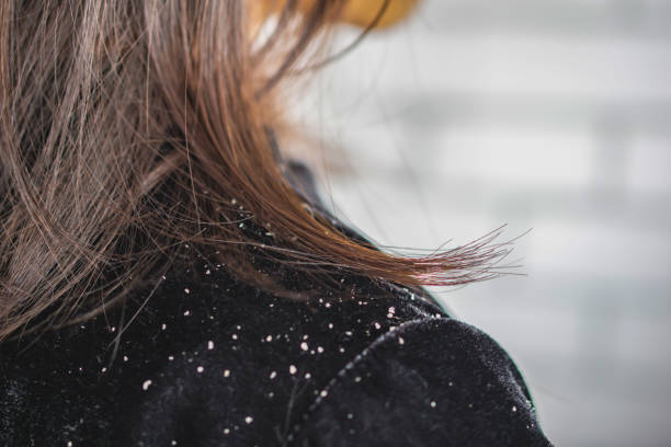 Dandruff Get Worse in Winter?